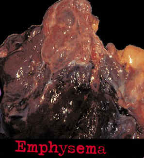 emphysema.jpg