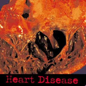 heart_disease.jpg